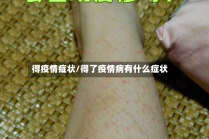 得疫情症状/得了疫情病有什么症状