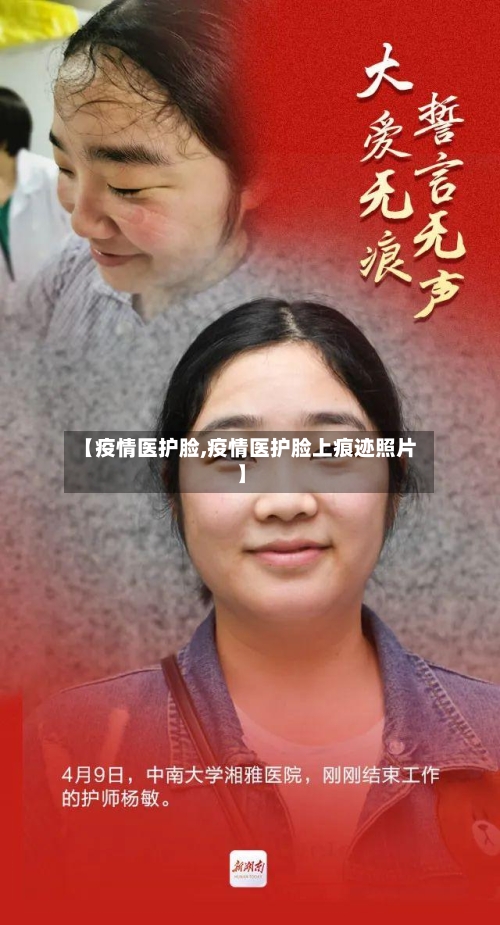【疫情医护脸,疫情医护脸上痕迹照片】-第1张图片